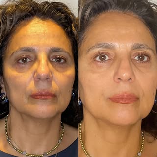 No buscamos transformar rostros.

Buscamos resultados naturales.

No se trata de poner más.
Se trata