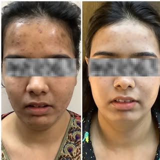 As a dermatologist, I see the impact acne has on confidence every day. But with the right care, clea