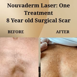 Nouvaderm Scar Treatment
Nouvaderm Scar Treatment is an advanced skin resurfacing procedure designed