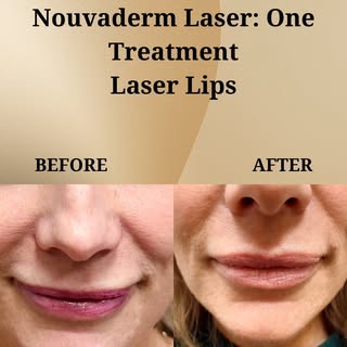 Want fuller, smoother lips… without filler?
Our Nouvaderm Laser Lip treatment stimulates collagen in