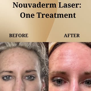 Nouvaderm Laser Resurfacing: 
Nouvaderm Laser Resurfacing is an advanced skin rejuvenation treatment
