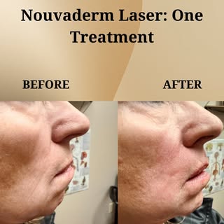 Turn back the clock on aging! ⏳✨ NOUVADerm can reduce fine lines and wrinkles by resurfacing the
ski