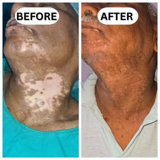 People with vitiligo patches, have faith..you are not alone in this battle..

Just look at this..✨️�