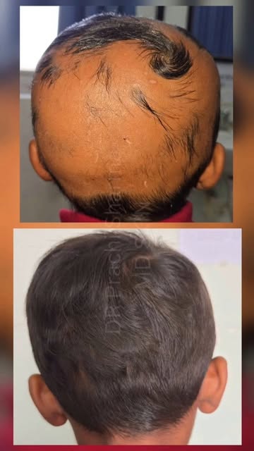 💫Full hair regrowth with no recurrence of hair loss even after stoppage of treatment.

Contact 7068