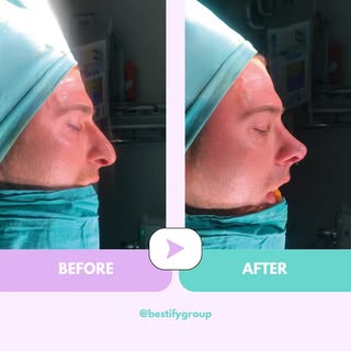 Aesthetic nose without the hump. Let's say we are good at getting rid of any kind of humps :)

For m