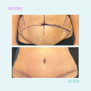 We know how hard can it be after a birth or a very fast lose of weight. You should know how easy wit