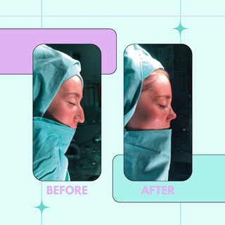 Aesthetic nose without the hump. Let's say we are good at getting rid of any kind of humps :)

For m