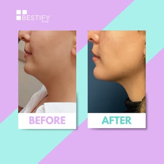 It is a chin, we don't want a double chin are we?

Reach us on social or on our website for a free c