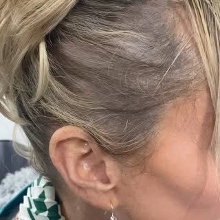 𝙇𝘼𝘿𝙄𝙀𝙎 📢 Scalp Micropigmentation could be the solution to conceal your thinning areas! Any de