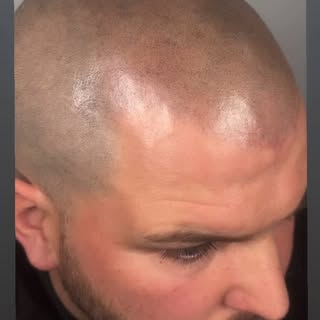 𝐋𝐞𝐭’𝐬 𝐮𝐩𝐠𝐫𝐚𝐝𝐞 👏🏼👏🏼 Scalp Micropigmentation has made such a huge difference for this g