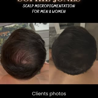 Healed photos - 2 sessions of SMP on my client who previously had a hair transplant, SMP is absolute