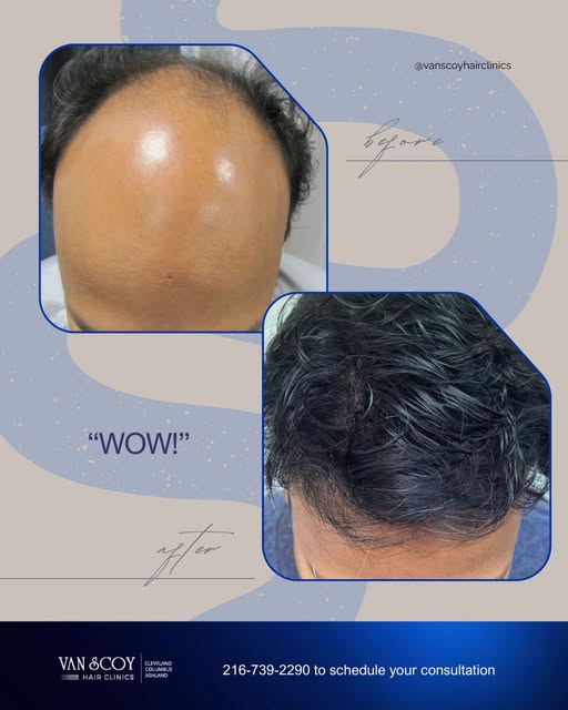 Now THAT is a transformation. 🔥

The right hair system doesn’t just add hair. It can completely cha
