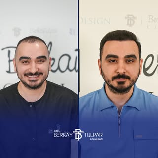 We’ve completed 12 months with Berkay Tulpar.
We performed a hair transplant with 3960 grafts using 