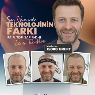Saç ekiminde sıradan çözümlerle yetinmeyin; teknolojinin ve doğru tekniğin farkını yaşayın! 

Özel B
