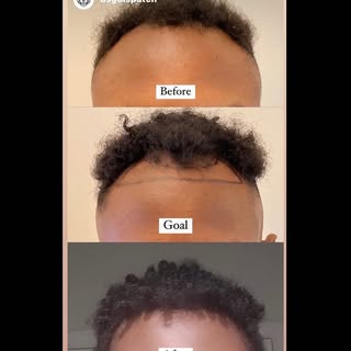 Just as hair loss is a gradual process, so is hair growth after restoration.  By about 3 months it b