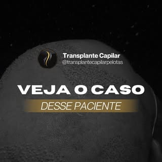 Foram 9 mil fios transplantados!😱

A coroa que era sua grande queixa foi totalmente preenchida e ai