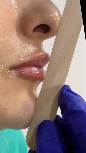 Lip aging is more than just loss of volume. 👄✨

With age, the upper lip can appear longer, the phil