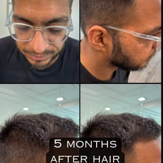 We often get asked what sets us apart from other clinics for a hair transplant? Choosing the right p