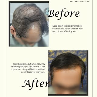 We let our results speak out ourselves! 😎

#beforeafter #gfc #hairtransplant #hair #bestresults #be