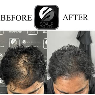 This client was looking to add density to his thinning hair, treatment complete after 3 sessions. 

