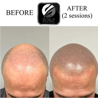 Before and after 2 sessions of Scalp Micropigmentation. Call today to schedule a FREE consultation.
