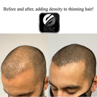 Great transformation adding density to this gentleman’s thinning hair. 

Call today to schedule a FR