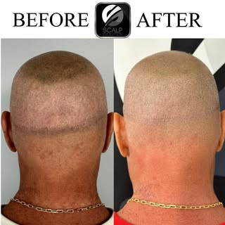 Unfortunately, this client had received subpar scar concealment treatment from another local provide
