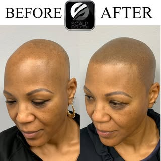 This wonderful lady came to us struggling with her hair loss. We were able to give her a give her a 