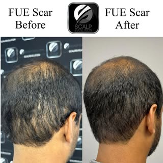FUE scar cover up. Call today to schedule a FREE consultation
Miami FL 🇺🇸 305-988-5338
Manchester 