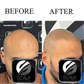 Treatment completed in just 2 session. Call today to schedule a FREE consultation. 
Miami FL 🇺🇸 30