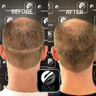 Hair transplant scar camouflaged with #scalpmicropigmentation. 

Call us today to schedule a FREE co