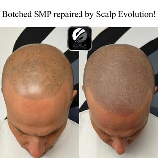 This gentleman came to us after undergoing multiple SMP sessions with another South FL provider. Our