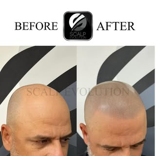 2 session and done! Call today to schedule a FREE consultation. 

Miami FL 🇺🇸 305-988-5338
Manches