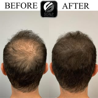 Density filling treatment completed with 3 session of Scalp Micropigmentation. 

Call today to sched