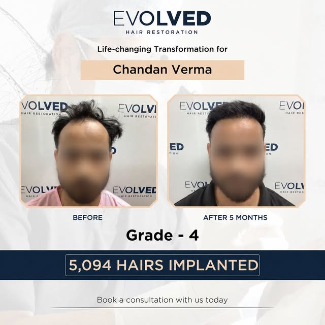 From Grade 4 hair loss to a visibly fuller hairline. ✨

Chandan Verma’s hair restoration journey — 5