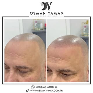 SMP Renewal ✔️

For detailed information and appointment;
📲 +90 (552) 570 32 08
📞 0(212) 270 00 08