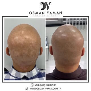 Commonly known as ringworm, alopecia is a disease that causes hair to be lost in a circular shape in