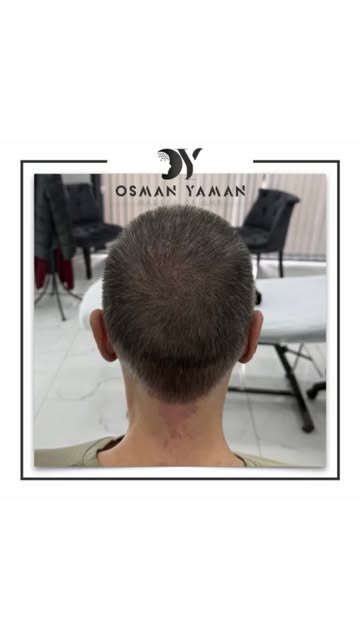 Before & After Scalp Micropigmentation Transformation ✔️

For detailed information and appointment;
