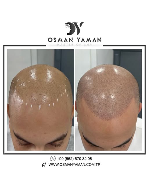Before & After Scalp Micropigmentation Transformation ✔️

For detailed information and appointment;
