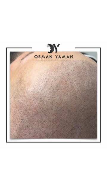 The technique we apply ensures that the process is like a hair root. ✔️💪🏽

For detailed informatio