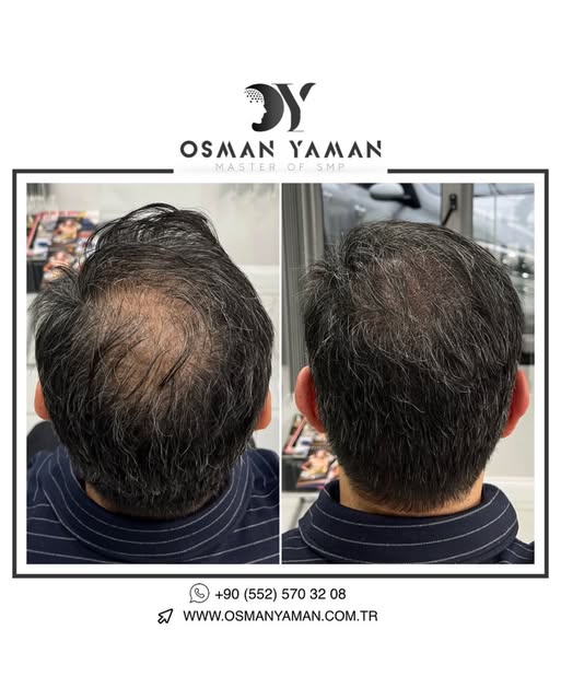Before & After Scalp Micropigmentation Transformation ✔️

For detailed information and appointment;
