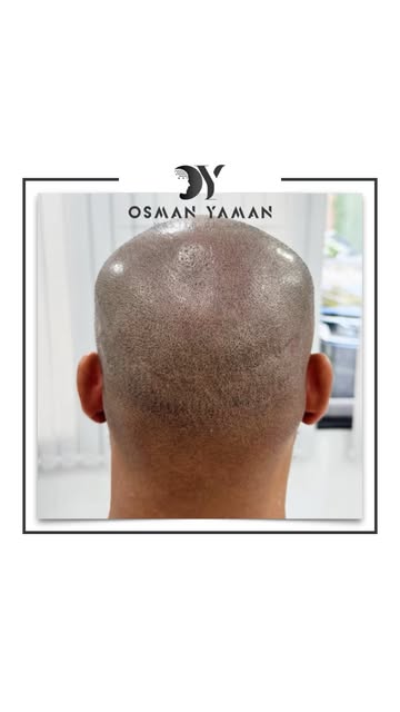 Scalp Micropigmentation Scar Camouflage techniques are used to flatten a scar and/or diminish the ap