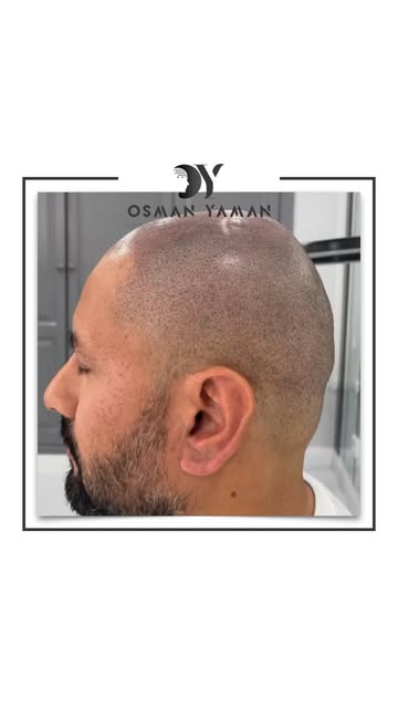 How it started vs how it’s going.. 🤫✔️

For detailed information and appointment;
📲 +90 (552) 570 