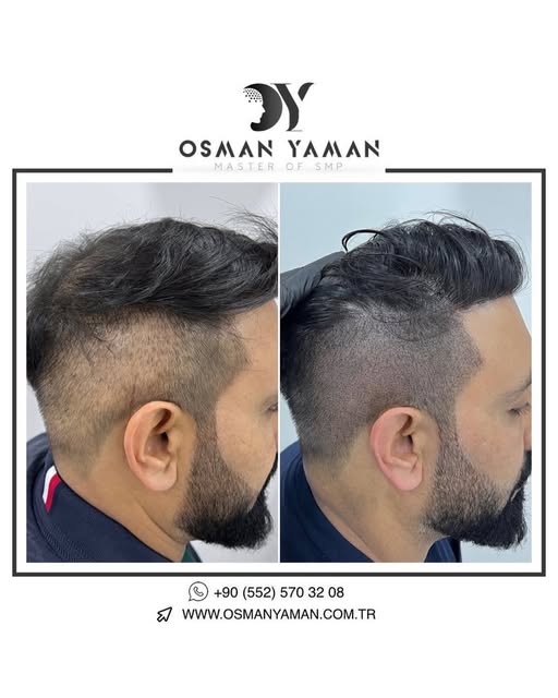 Before & After Scalp Micropigmentation Transformation ✔️

For detailed information and appointment;
