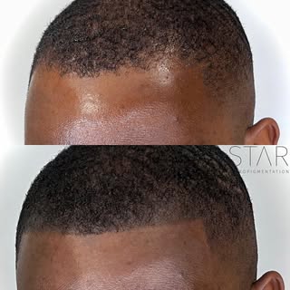 The High Definition Hairline 
Works for both Density Effect and Shaved Effect💫
.

✅ 100% Non-Invasi