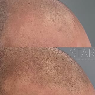 Can you distinguish SMP from Hair? #Zoomin #SMPVSHAIR 
Our Specialty, The Natural Hairline 💫💫💫
•
