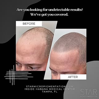 Do what makes you Happy, Remember Confidence is key!🎶
- HPC (Hair Per CM)
- Follicle Color
- Follic