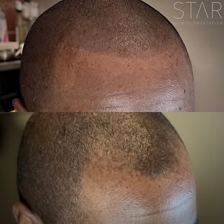 Hairline filled to perfection! Session 1
#blessed 
One of my favorite parts of a great SMP job is th