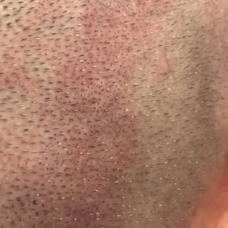 Check out the Scar Camo results after just 1 session!💫
- HPC (Hair Per CM)
- Follicle Color
- Folli