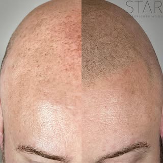 Did you know that SMP doesn’t just give you a great hairline? 🌟 It’s also a fantastic solution to c